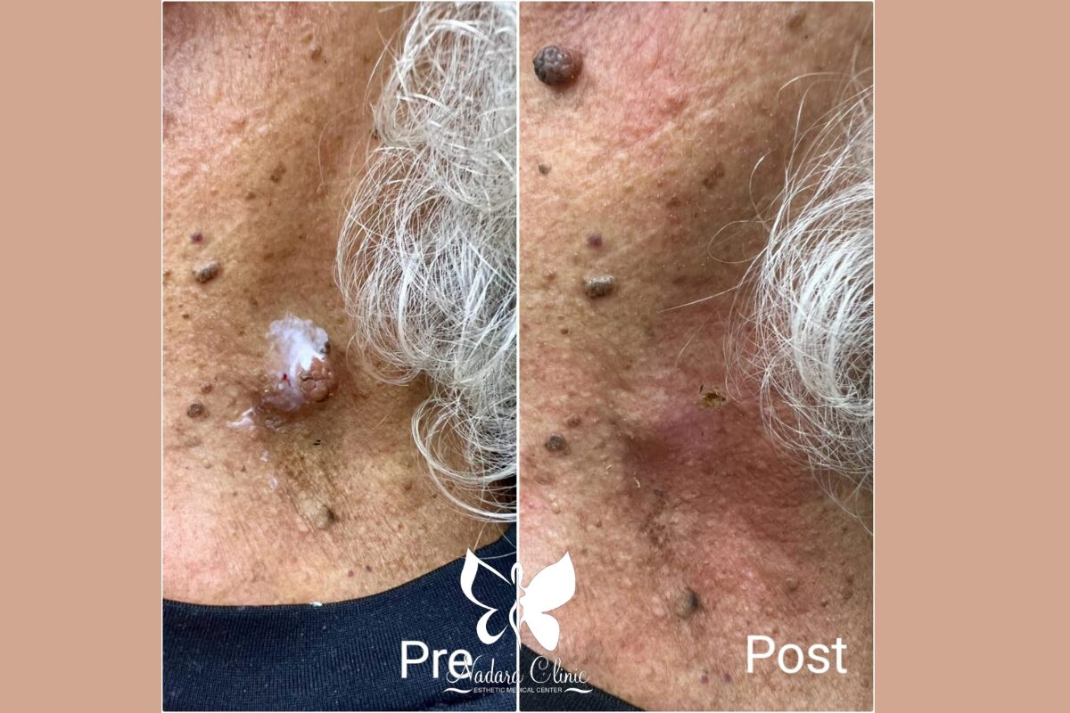 إزالة التقرن الدهني في الغردقة